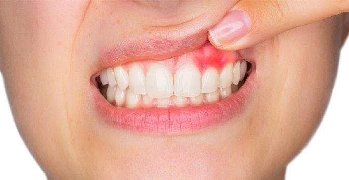 Gingivitis