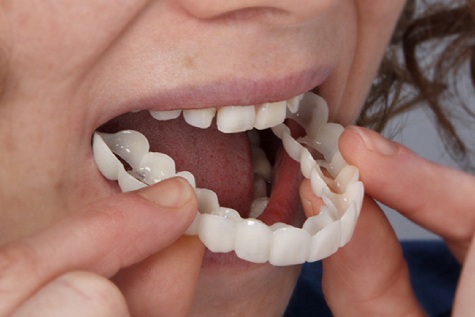 Snap-On Smile